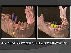 インプラント術前検査