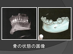 歯周外科術前検査