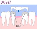 ブリッジ