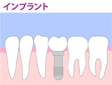 インプラント治療（人工歯根）