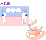 入れ歯（義歯）