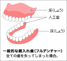 一般的な総入れ歯（フルデンチャー）