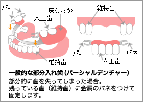 一般的な総入れ歯（フルデンチャー）