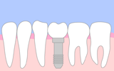 インプラント