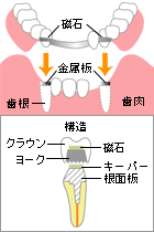 アタッチメント義歯