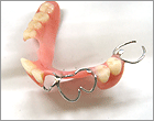 クラスプ義歯
