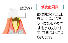 重度の歯周炎